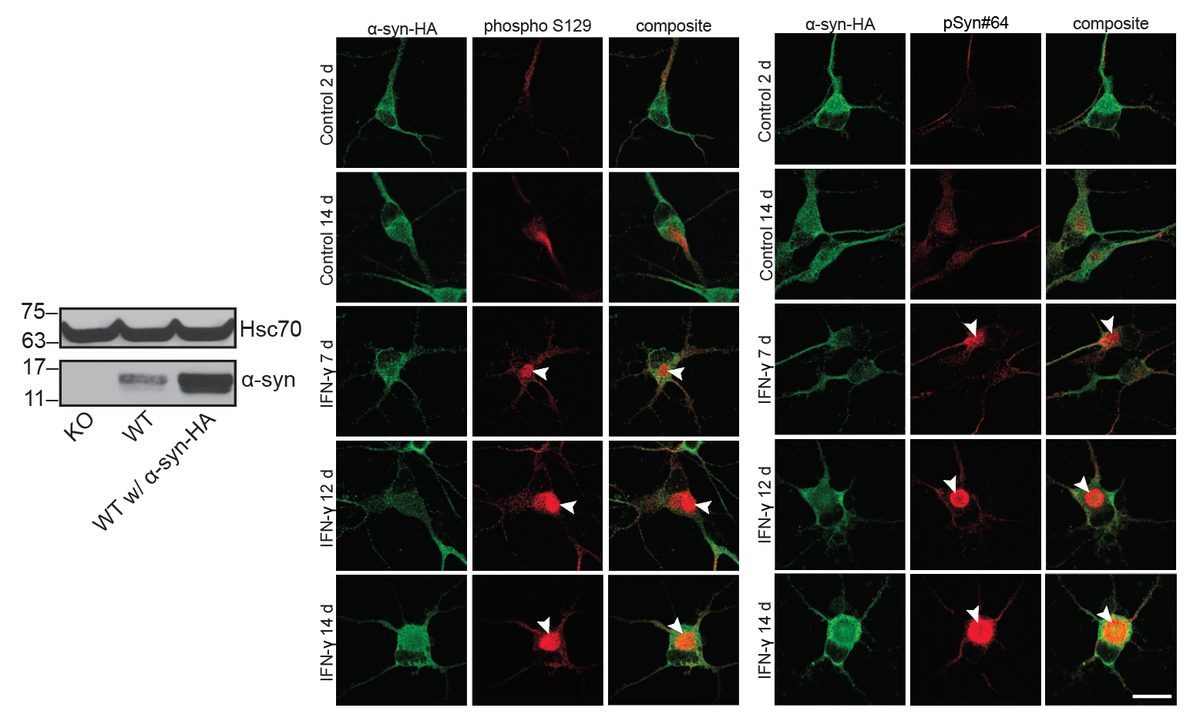 Adenovirus α-synuclein-HA overexpression with pSyn panels and Western blot across treatment conditions