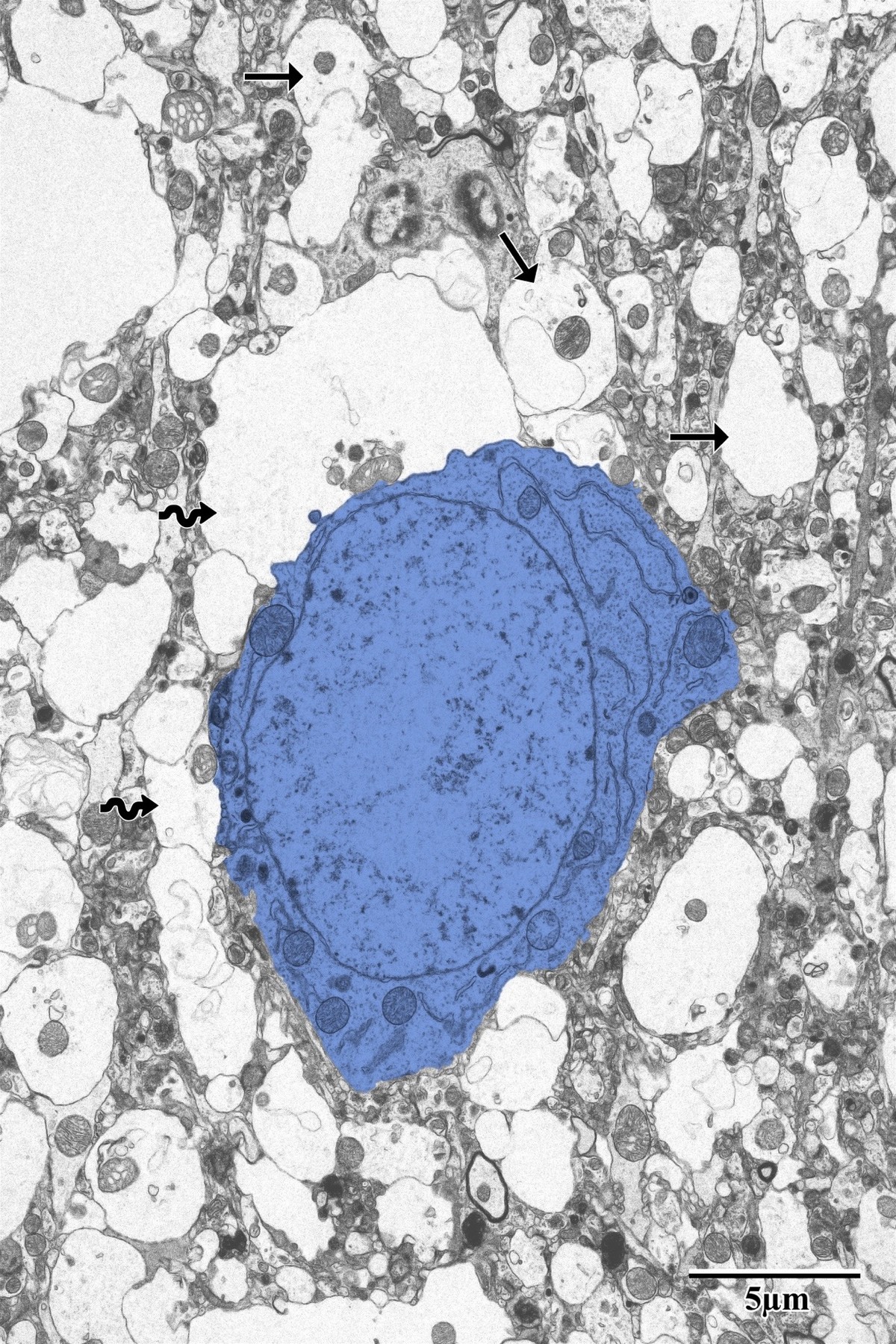 Proximal peri-infarct neuron showing advanced degeneration
