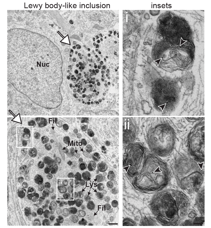 EM: Lewy body–like inclusion at low and high magnification