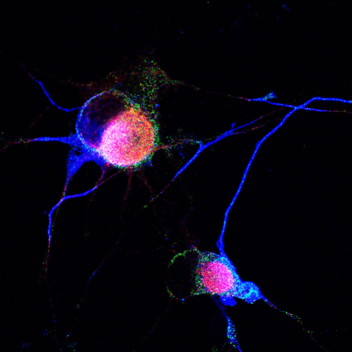 Syn-HA and phospho-synuclein colocalization in iPSC neurons