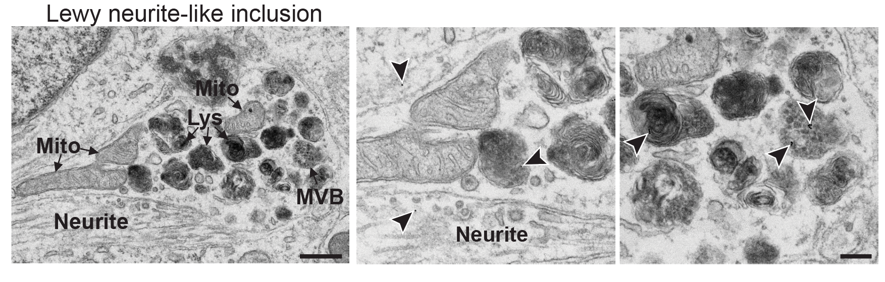 EM: Lewy neurite–like inclusions in neuronal processes